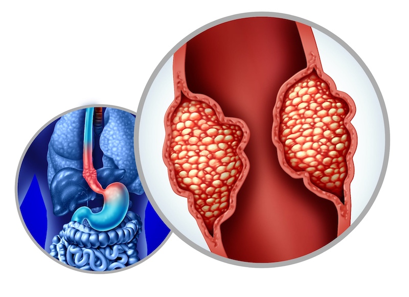Esophageal Precancer Testing Program Launched at Hoag