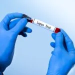 Lupus Testing Breakthrough: Is a New Gold Standard on the Horizon?