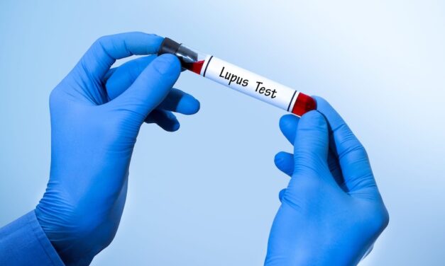 Lupus Testing Breakthrough: Is a New Gold Standard on the Horizon?