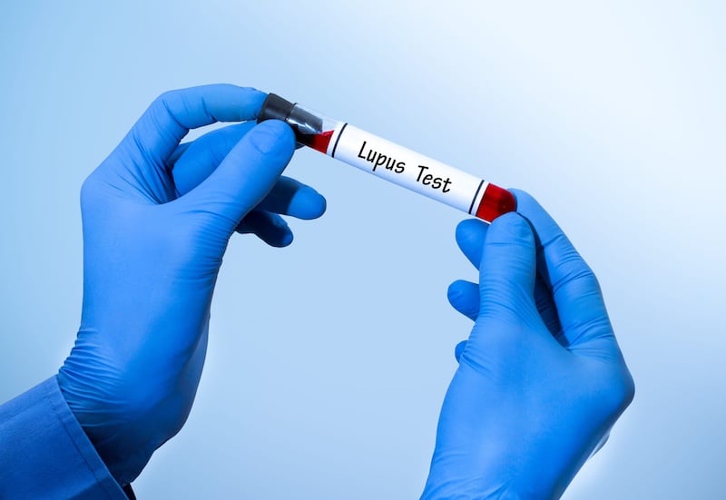 Lupus Testing Breakthrough: Is a New Gold Standard on the Horizon?
