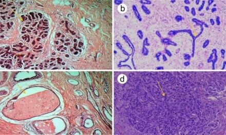 ATR-FTIR Spectroscopy Evaluated on Breast Tissue, Tumors