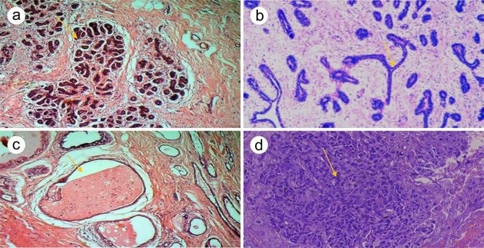 ATR-FTIR Spectroscopy Evaluated on Breast Tissue, Tumors