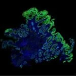 Improving Barrett’s Esophagus Risk Stratification with AI-Powered Spatialomics