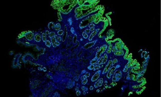Improving Barrett’s Esophagus Risk Stratification with AI-Powered Spatialomics