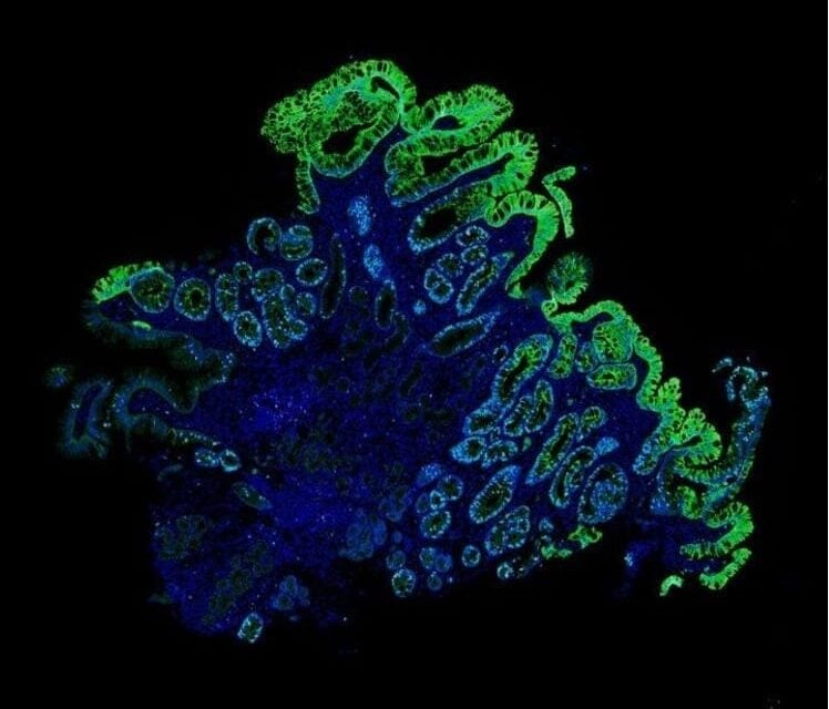 Improving Barrett’s Esophagus Risk Stratification with AI-Powered Spatialomics