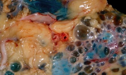 Blood Test Can Predict Kidney Disease Trajectories