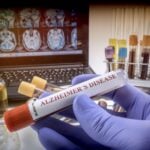 Quest Diagnostics to Offer Fujirebio Blood Test for Alzheimer’s