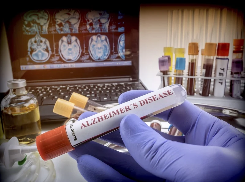 Quest Diagnostics to Offer Fujirebio Blood Test for Alzheimer’s