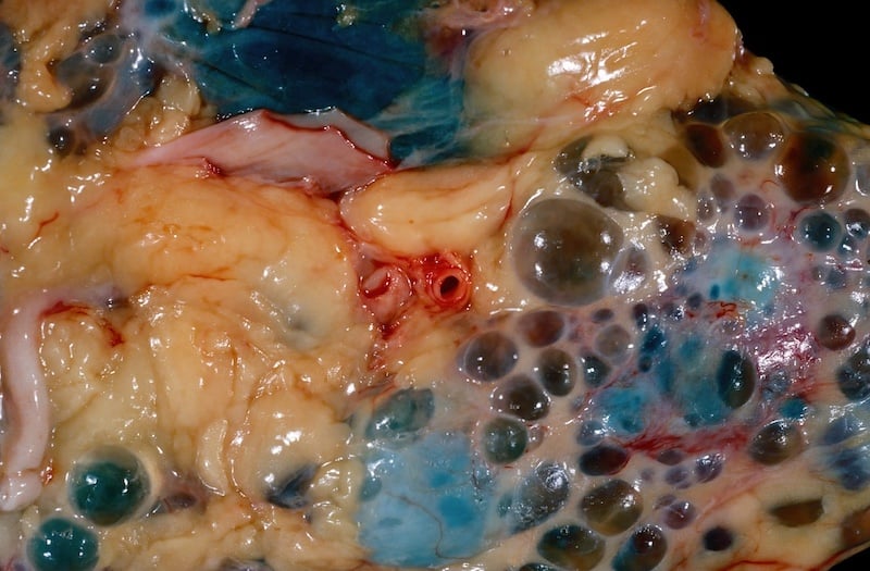Blood Test Can Predict Kidney Disease Trajectories