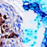 Pancreatic Cancer Has Genetic Early Warning System