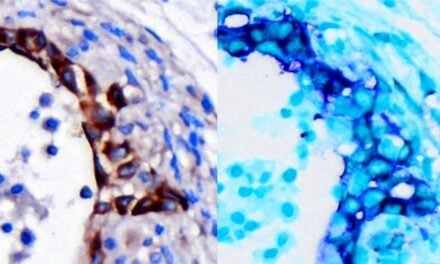 Pancreatic Cancer Has Genetic Early Warning System