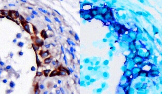 Pancreatic Cancer Has Genetic Early Warning System