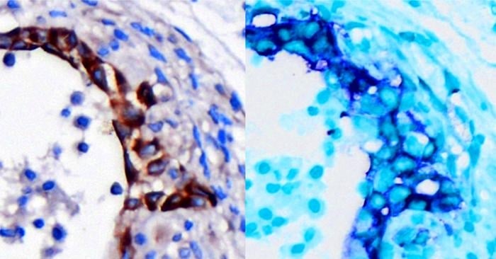 Pancreatic Cancer Has Genetic Early Warning System