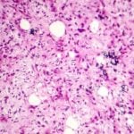 microRNAs Emerge as Biomarkers, Diagnostic Tools in Soft Tissue Sarcoma