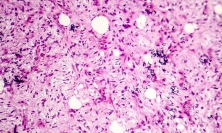 microRNAs Emerge as Biomarkers, Diagnostic Tools in Soft Tissue Sarcoma