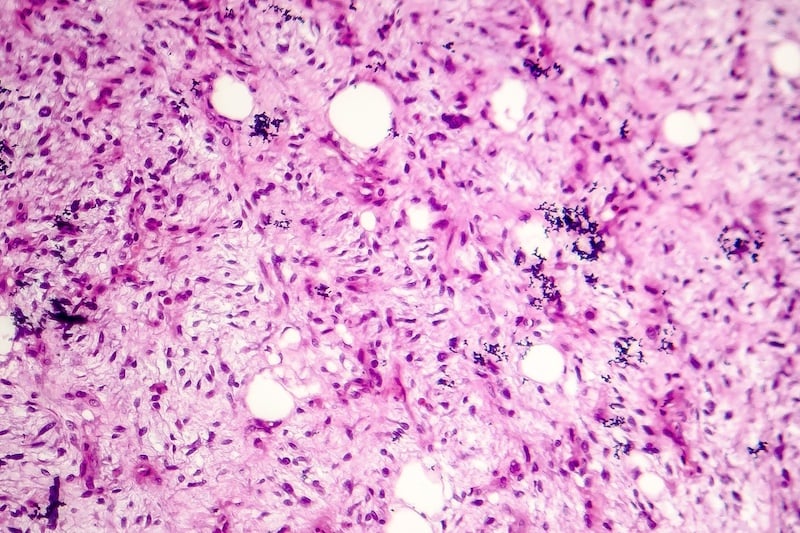 microRNAs Emerge as Biomarkers, Diagnostic Tools in Soft Tissue Sarcoma