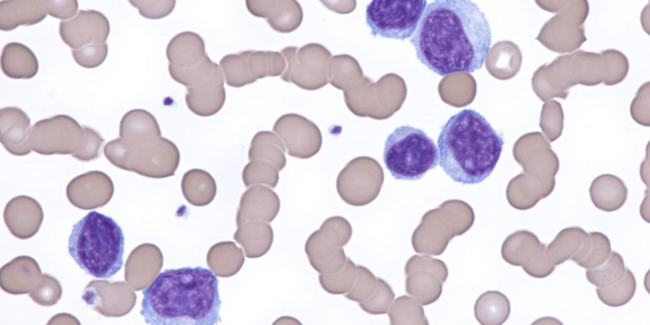 Ultrasensitive MRD Test Shows Greater Prognostic Accuracy Than PET/CT in Lymphoma