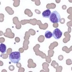 Ultrasensitive MRD Test Shows Greater Prognostic Accuracy Than PET/CT in Lymphoma