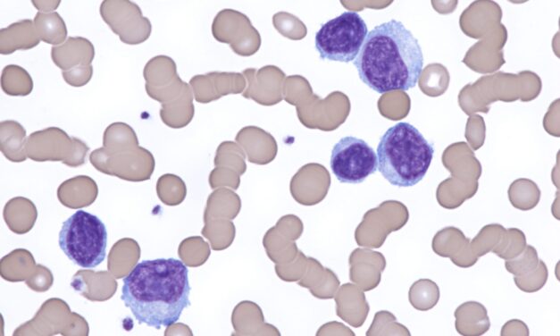 Ultrasensitive MRD Test Shows Greater Prognostic Accuracy Than PET/CT in Lymphoma