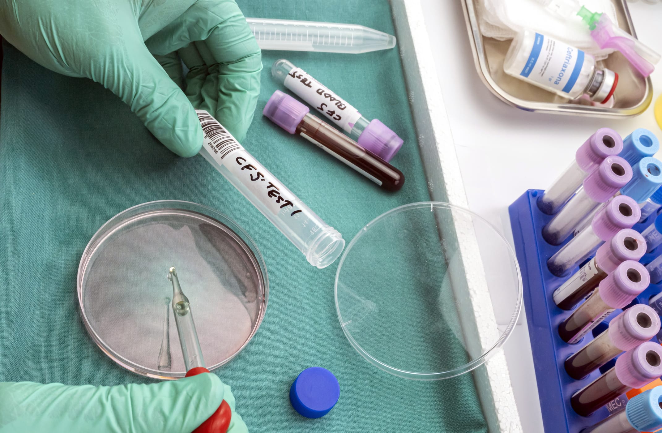 CLIA Accreditation Clears Path for CNSide Diagnostics’ CSF Assay ...