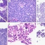 Study Supports Exclusion of Cervical Serous Carcinoma from WHO Classification