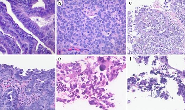 Study Supports Exclusion of Cervical Serous Carcinoma from WHO Classification