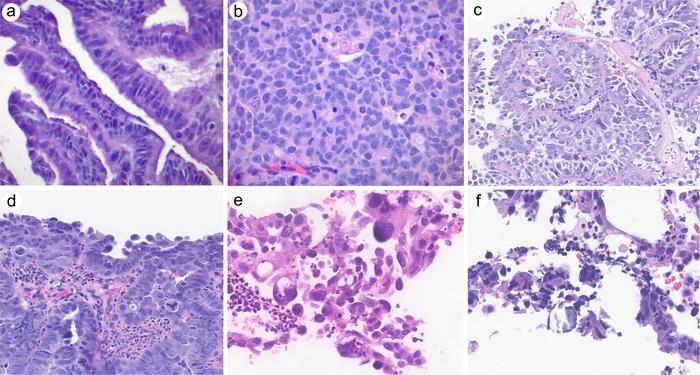 Study Supports Exclusion of Cervical Serous Carcinoma from WHO Classification