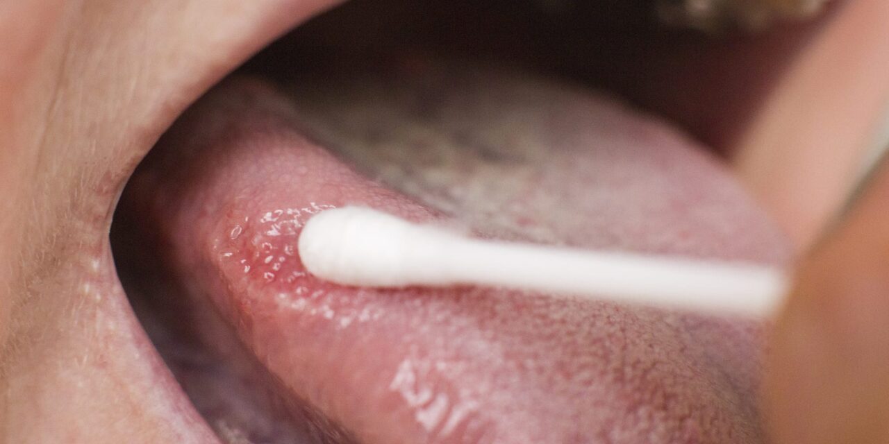 CRISPR-Based TB Test Detects Infection From Tongue Swabs