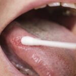 CRISPR-Based TB Test Detects Infection From Tongue Swabs