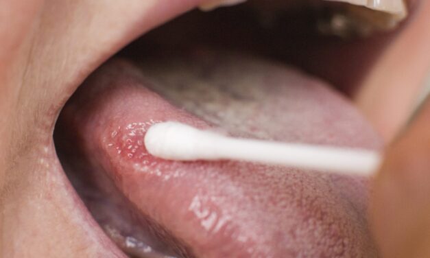 CRISPR-Based TB Test Detects Infection From Tongue Swabs