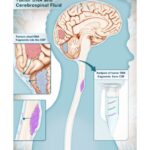 Cerebrospinal Fluid Test Identifies Brain Cancers with 100% Specificity