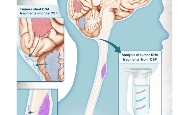 Cerebrospinal Fluid Test Identifies Brain Cancers with 100% Specificity