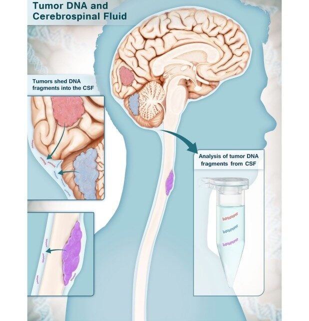 Cerebrospinal Fluid Test Identifies Brain Cancers with 100% Specificity