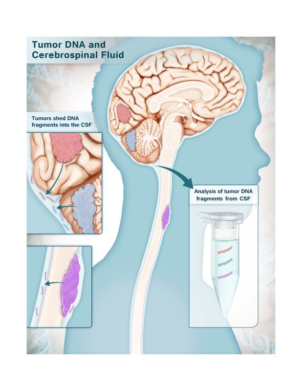 Cerebrospinal Fluid Test Identifies Brain Cancers with 100% Specificity ...