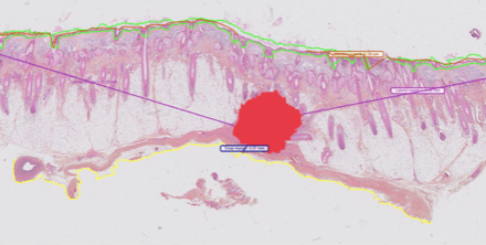Proscia Expands AI Capabilities to Support Skin Pathology Evaluation