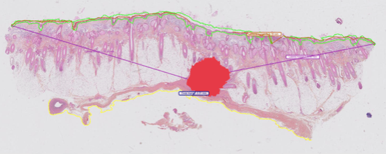 Proscia Expands AI Capabilities to Support Skin Pathology Evaluation