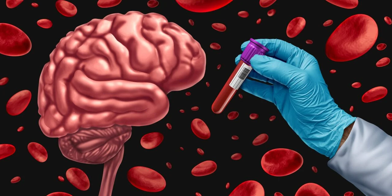 Study Demonstrates Accuracy of Two Quest Blood Tests for Alzheimer’s Diagnosis