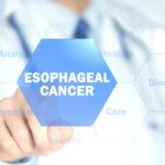 Study Validating Esophageal Cancer Test Accepted by Gastroenterology Journal