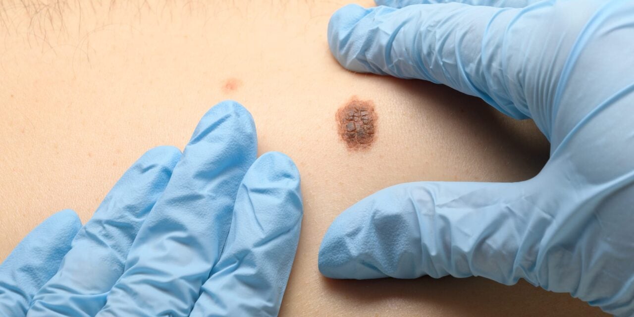 Large Melanoma Trial Validates Gene Expression Test’s Predictive Accuracy