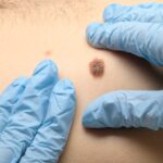 Large Melanoma Trial Validates Gene Expression Test’s Predictive Accuracy