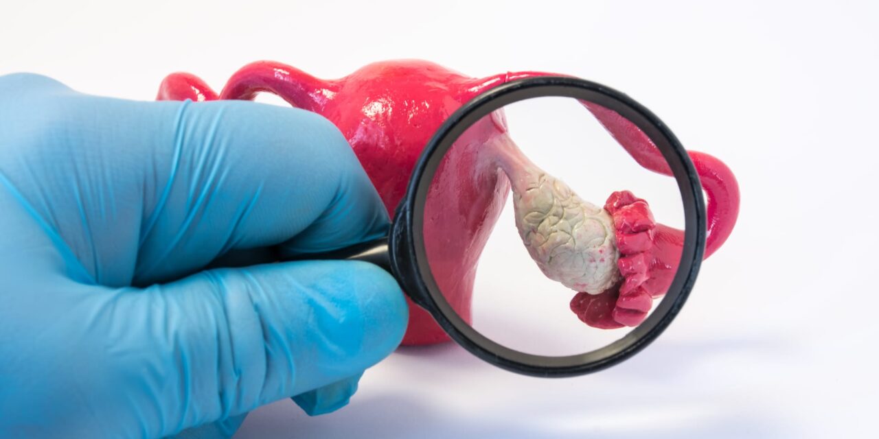 Blood Test Shows High Accuracy for Early Ovarian Cancer Detection