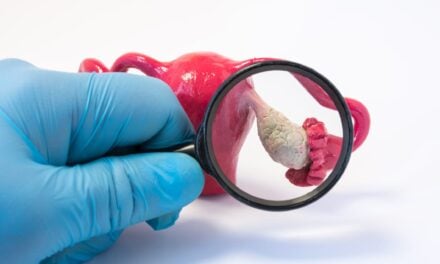 Blood Test Shows High Accuracy for Early Ovarian Cancer Detection