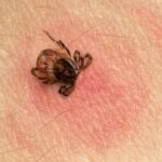 Novel Single-Tier Lyme Disease Tests Show Superior Early Detection