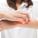 Castle Biosciences Launches Test to Guide Atopic Dermatitis Treatment Selection