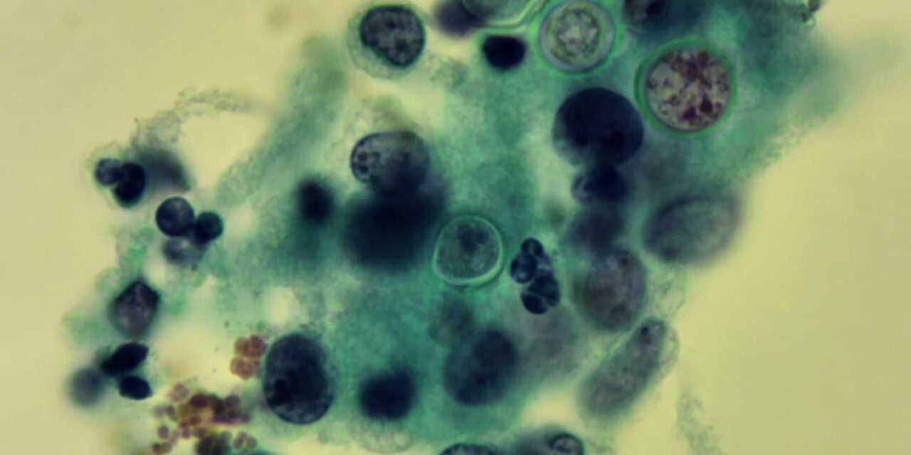 New Molecular Test Detects Three Regional Fungal Infections Simultaneously