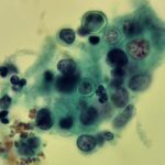New Molecular Test Detects Three Regional Fungal Infections Simultaneously