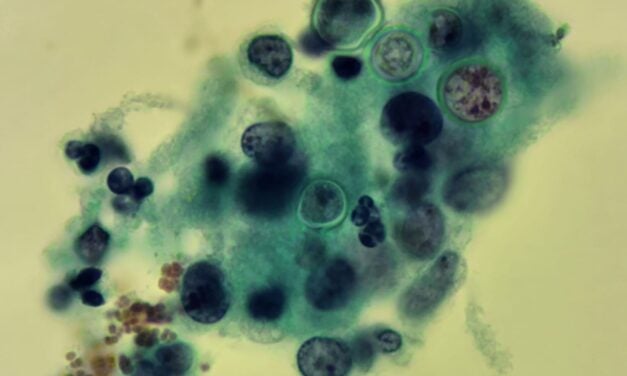 New Molecular Test Detects Three Regional Fungal Infections Simultaneously