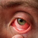 Tear-Based Diagnostic Test for Red Eye Conditions Enters Clinical Study