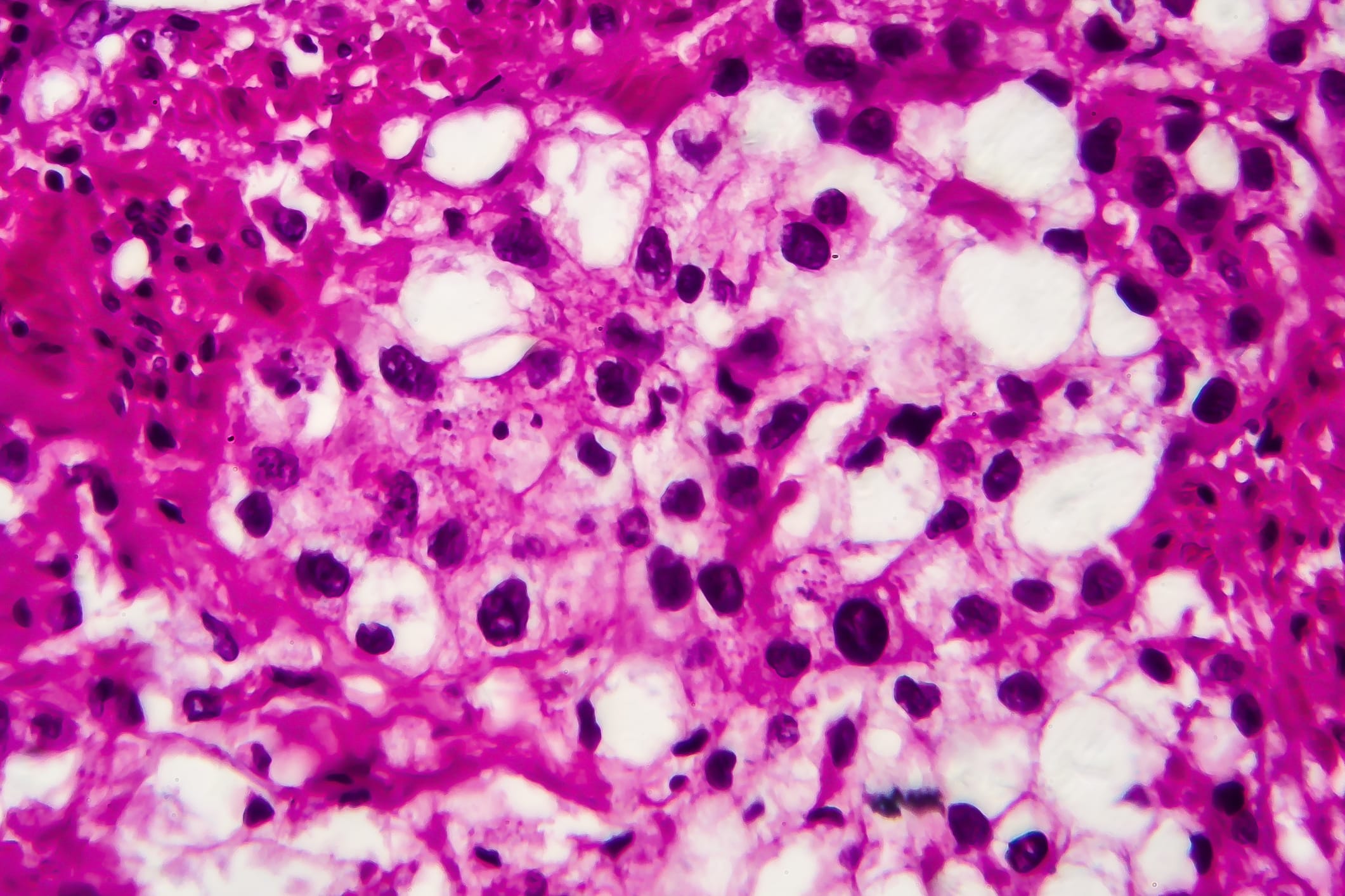 Valar Labs Partners with PathNet Lab to Expand AI Bladder Cancer ...