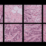 Harvard Researchers Identify Bias in AI Pathology Models